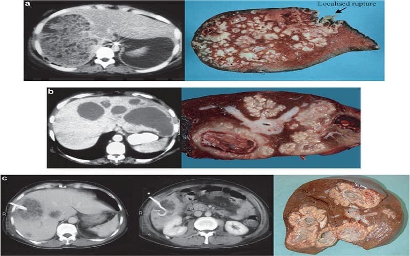 phác đồ điều trị áp xe gan bộ y tế