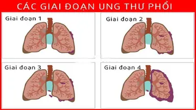 Phác đồ điều trị ung thư phổi giai đoạn 3 chưa di căn