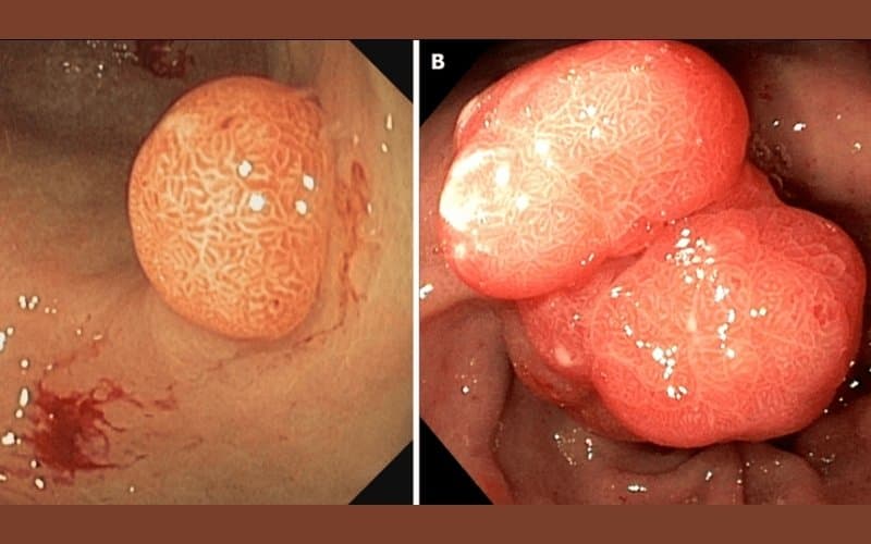 polyp dạ dày có phải là ung thư không
