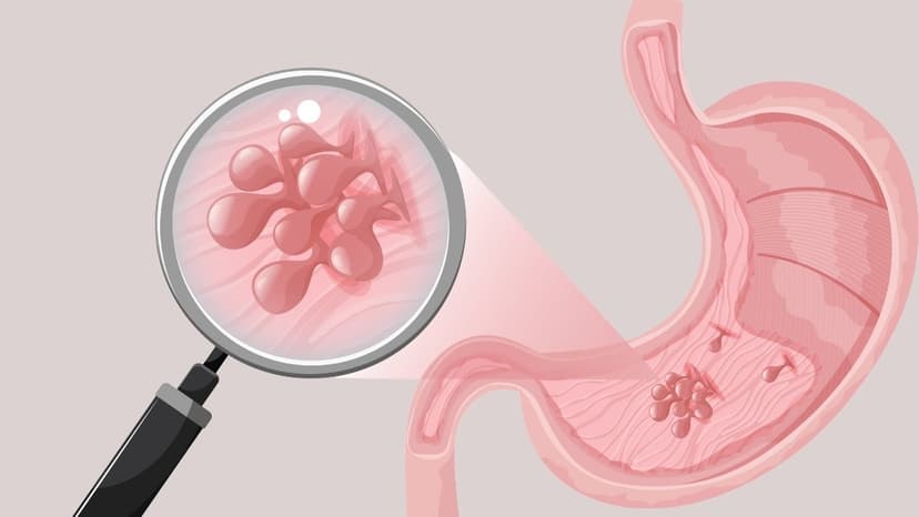 Polyp dạ dày có phải là ung thư không?