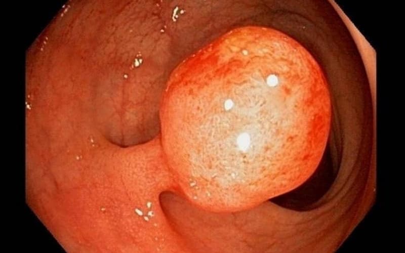 nội soi cắt polyp dạ dày