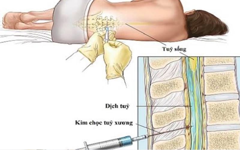 chọc tủy xét nghiệm viêm màng não