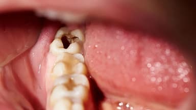 Răng số 7 bị sâu vỡ có nên nhổ không?