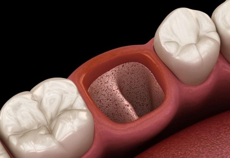 sau khi nhổ răng khôn bao lâu thì được đánh răng