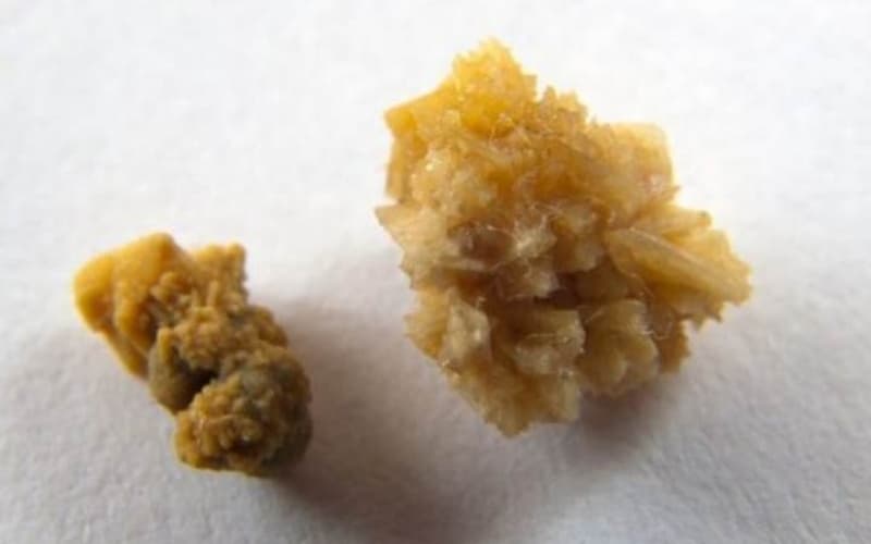 sỏi tiết niệu có bao nhiêu loại