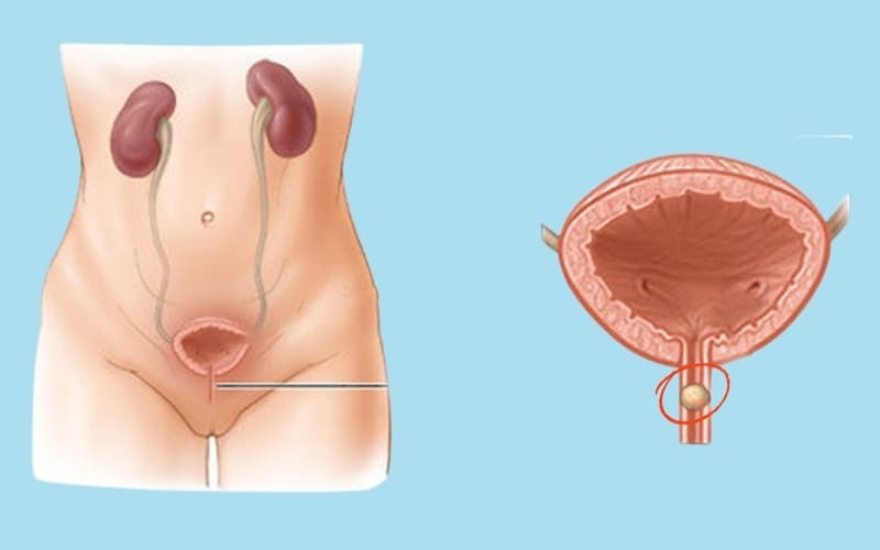 sỏi niệu đạo có nguy hiểm không