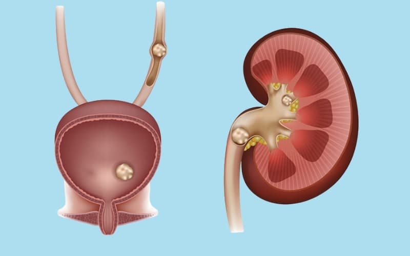 sỏi tiết niệu có bao nhiêu loại