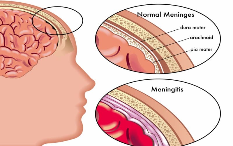 viêm màng não do virus có nguy hiểm không