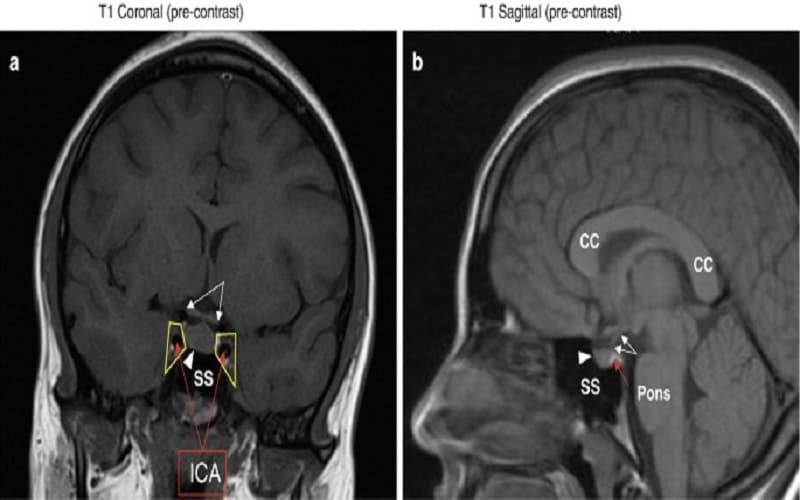 suy tuyến yên ở nam