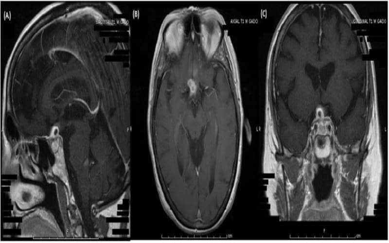 xét nghiệm suy tuyến yên