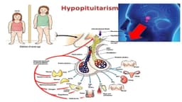 Suy tuyến yên là bệnh gì? Nguyên nhân?