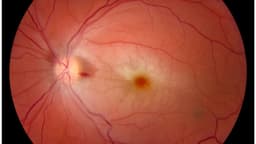 Tắc động mạch trung tâm võng mạc là bệnh gì?
