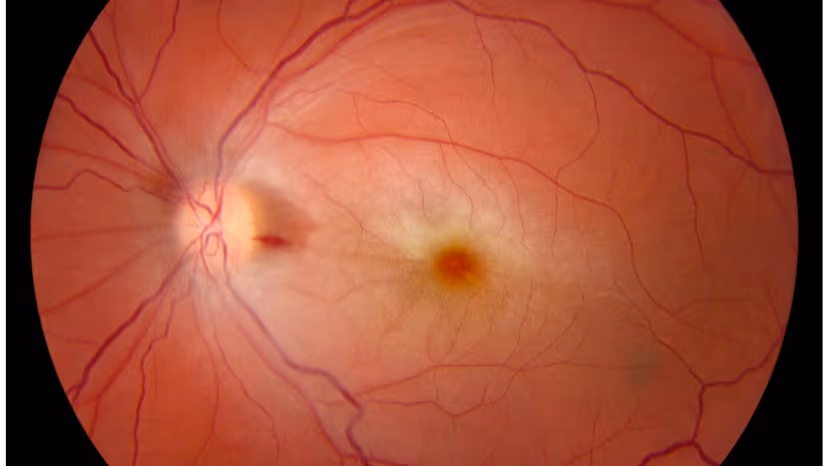 Tắc động mạch trung tâm võng mạc là bệnh gì?