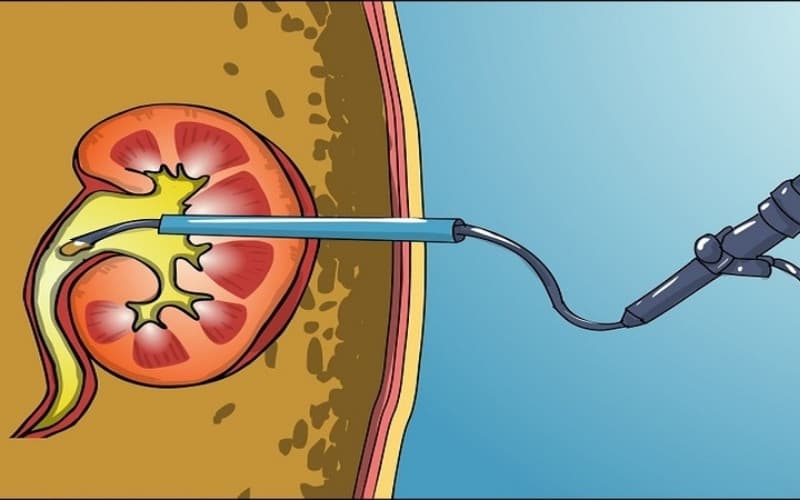 sỏi niệu quản khi nào cần mổ