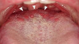 Tăng sinh mô lympho đáy lưỡi thành họng có nguy hiểm không?