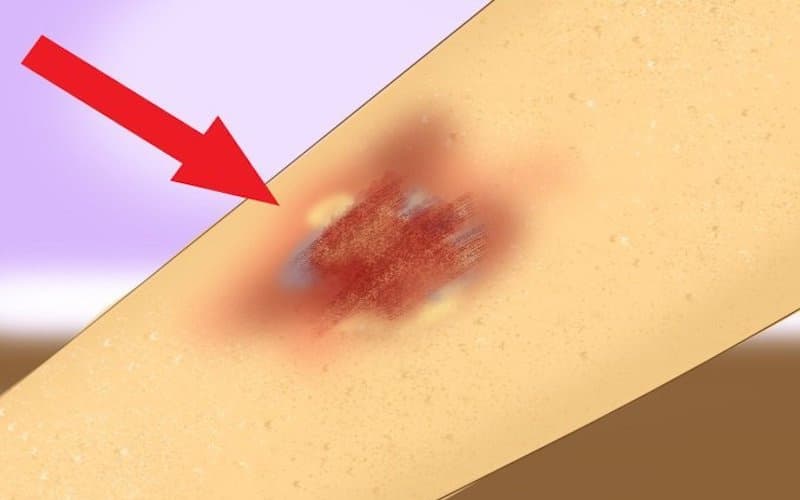 triệu chứng kháng thuốc kháng sinh