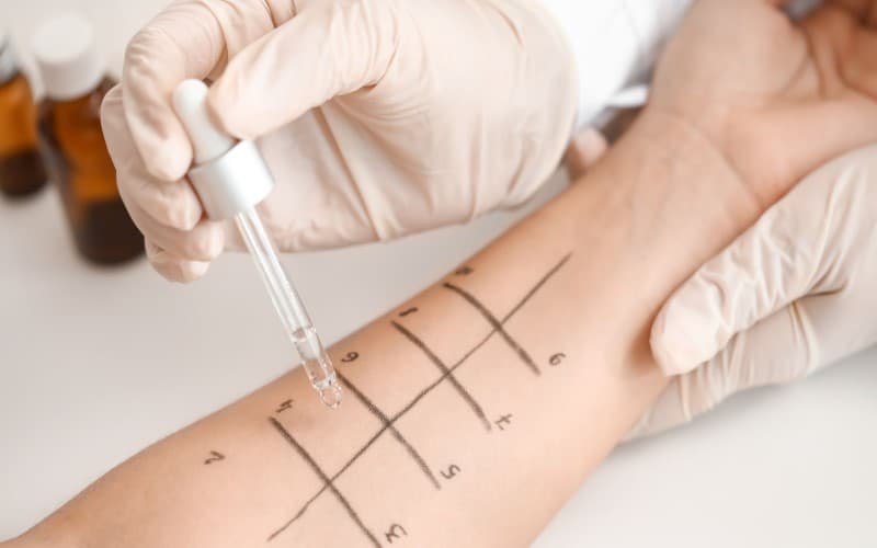 test dị ứng kháng sinh