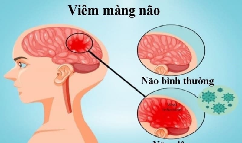 viêm màng não có mấy loại