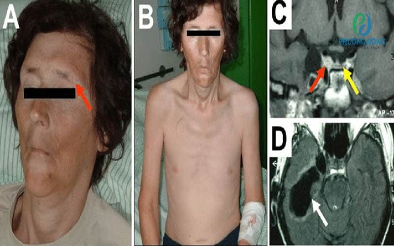 dấu hiệu suy tuyến yên