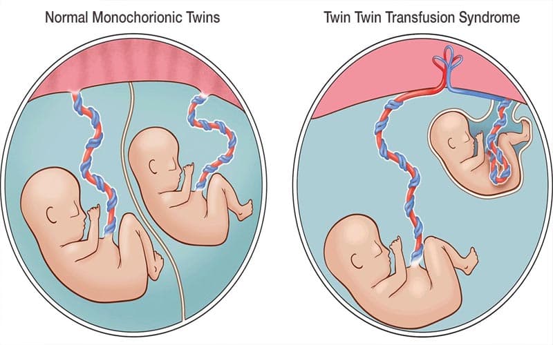truyền máu song thai là gì?