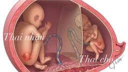 Truyền máu song thai thường xảy ra tuần thứ mấy?