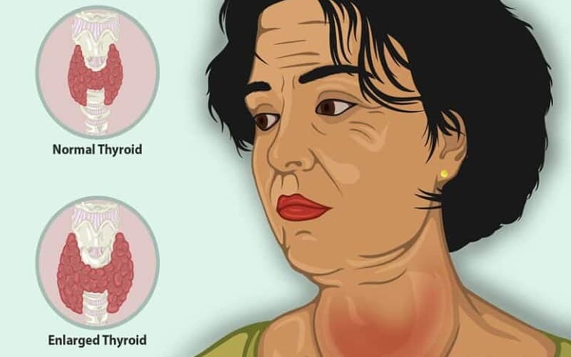 nguyên nhân tăng sinh mạch máu tuyến giáp