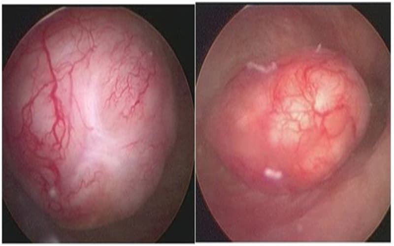u lành tính có tăng sinh mạch máu không