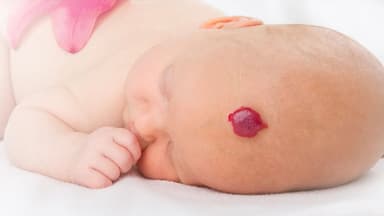 Cách điều trị u máu sơ sinh