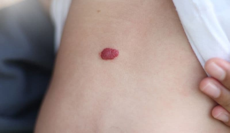 u máu ở trẻ sơ sinh có tự hết không