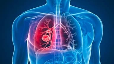 Ung thư phổi giai đoạn 2 có nguy hiểm không?