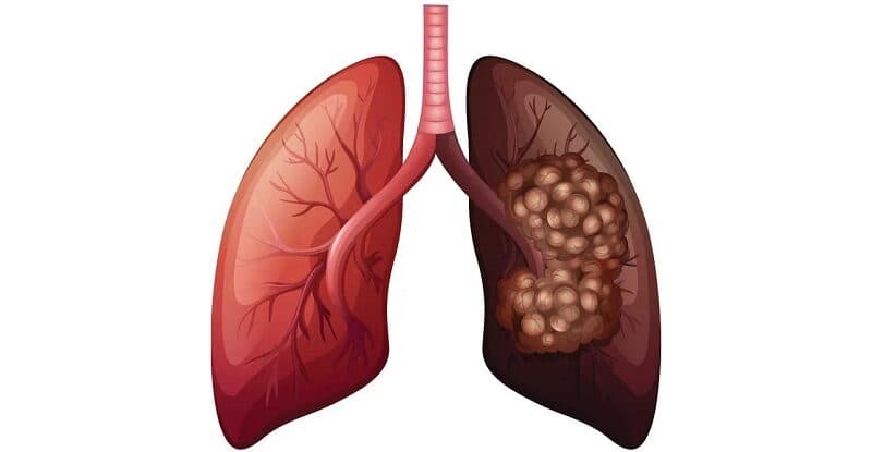 ung thư phổi không tế bào nhỏ