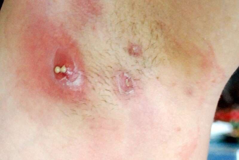 viêm tuyến mồ hôi mủ