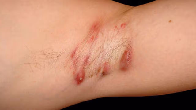 Viêm tuyến mồ hôi mủ là gì? Nguyên nhân, điều trị