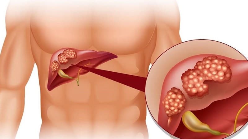 xét nghiệm máu có phát hiện bệnh gan không