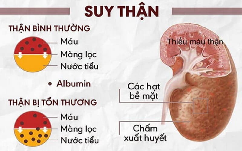 xét nghiệm nước tiểu có ra suy thận không