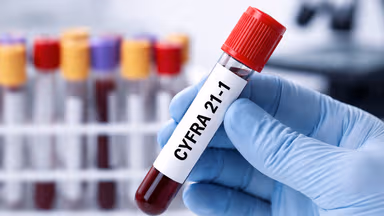 Các xét nghiệm tầm soát ung thư phổi