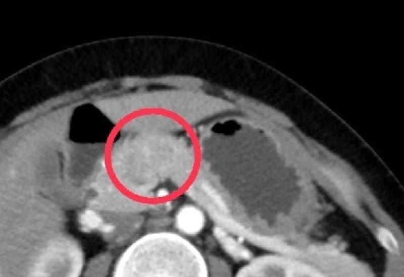 siêu âm có phát hiện ung thư tuyến tụy