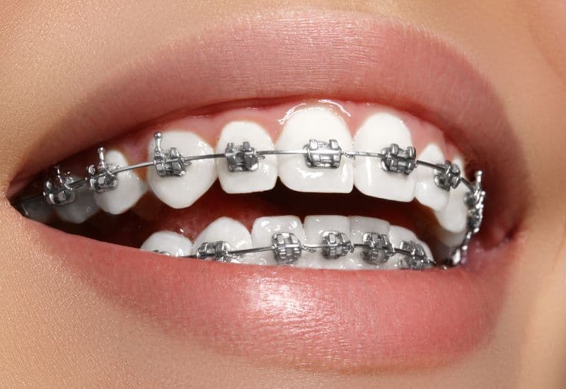 40 tuổi niềng răng mất bao lâu