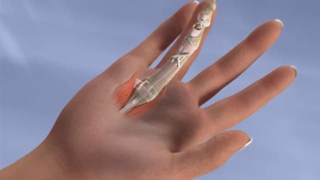 Đứt gân duỗi ngón tay bao lâu thì lành: Thời gian hồi phục và lưu ý