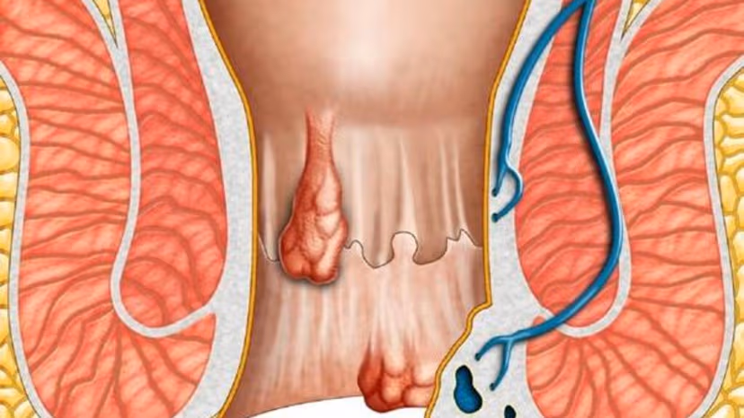 Có cần cắt da thừa hậu môn sau cắt trĩ không?