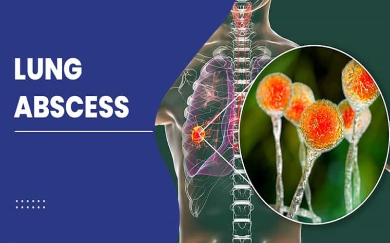 áp xe phổi là gì