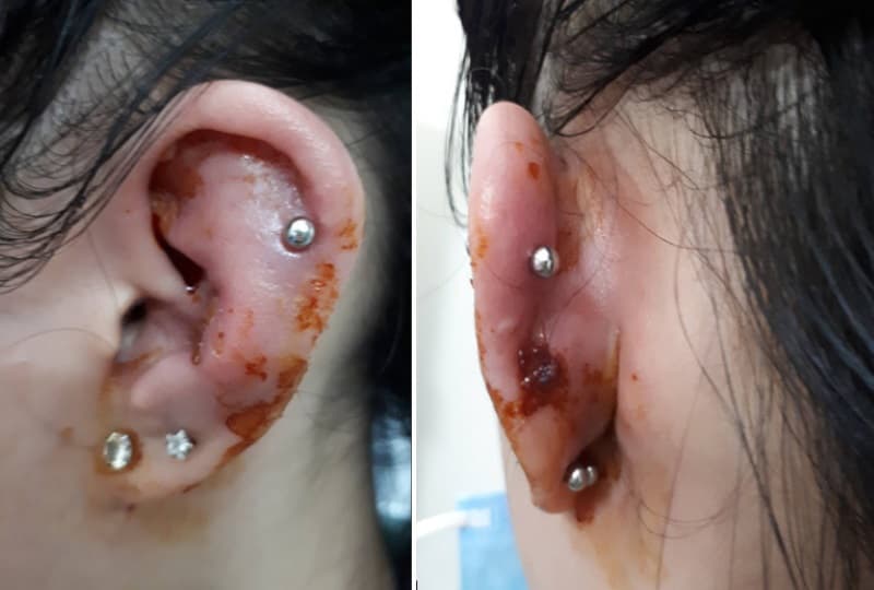 áp xe sụn vành tai