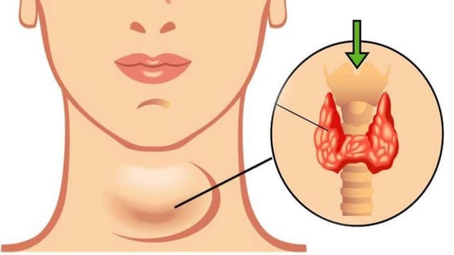 Tại sao cường giáp gây suy tim?