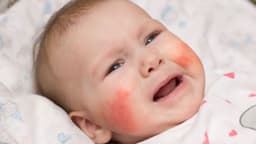 Bệnh lupus ban đỏ ở trẻ em có nguy hiểm không?