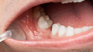 Bị mất răng hàm dưới có sao không?