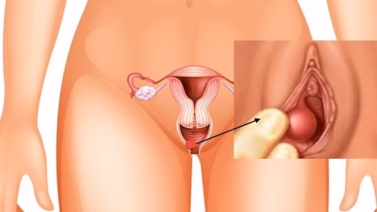 Bóc tách tuyến bartholin có bị khô hạn không? Bao lâu thì quan hệ được?