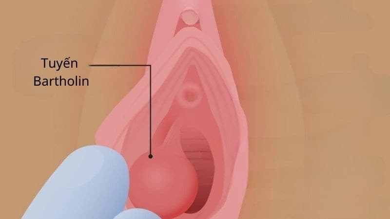 bóc tách tuyến bartholin có bị khô hạn không