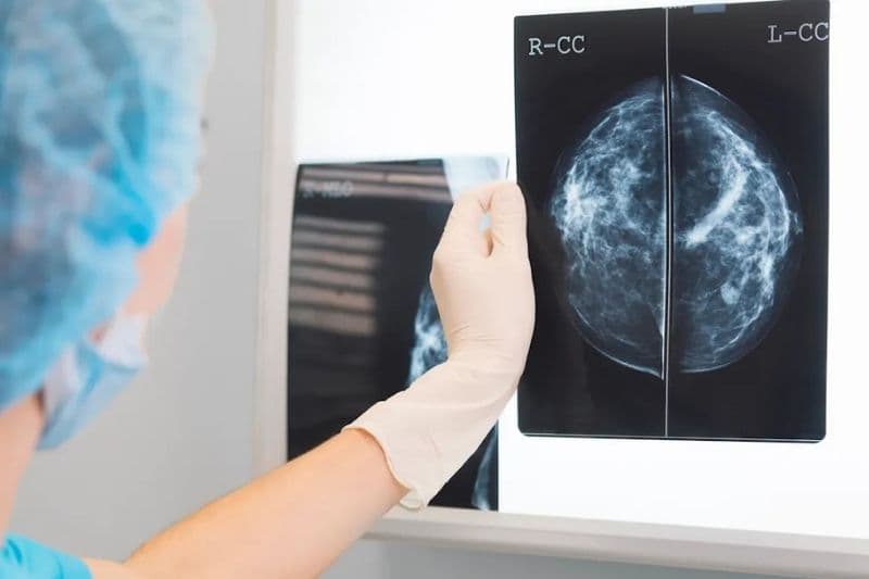 nguyên nhân ung thư vú