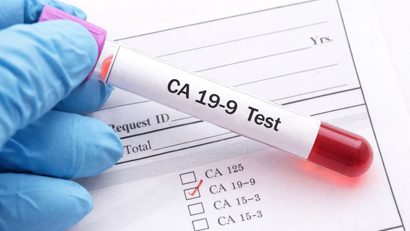 Xét nghiệm CA 19-9 ung thư tụy có ý nghĩa và giá trị như thế nào?