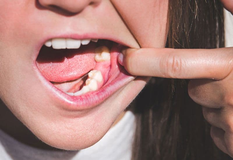 cách khắc phục mặt lệch do mất răng